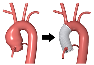 Aortic Care Jefferson Health