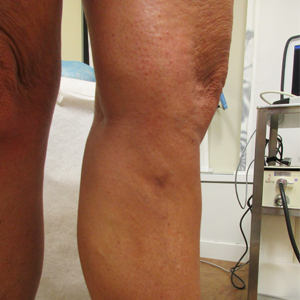 Vein Care - Gallery | Jefferson Health