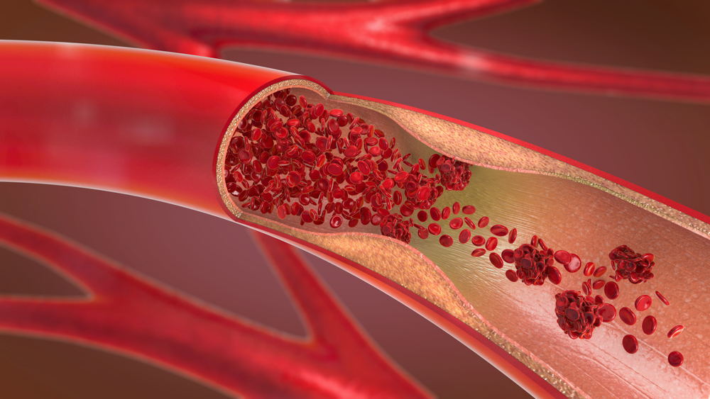 Endovascular Revascularization | Jefferson Health