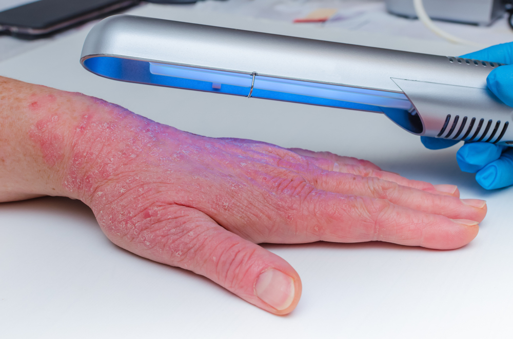 blue light therapy for psoriasis