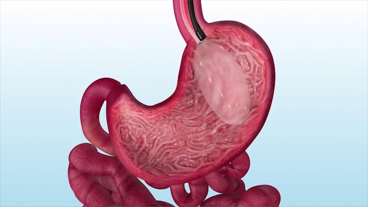 Intragastric Balloon | Jefferson Health